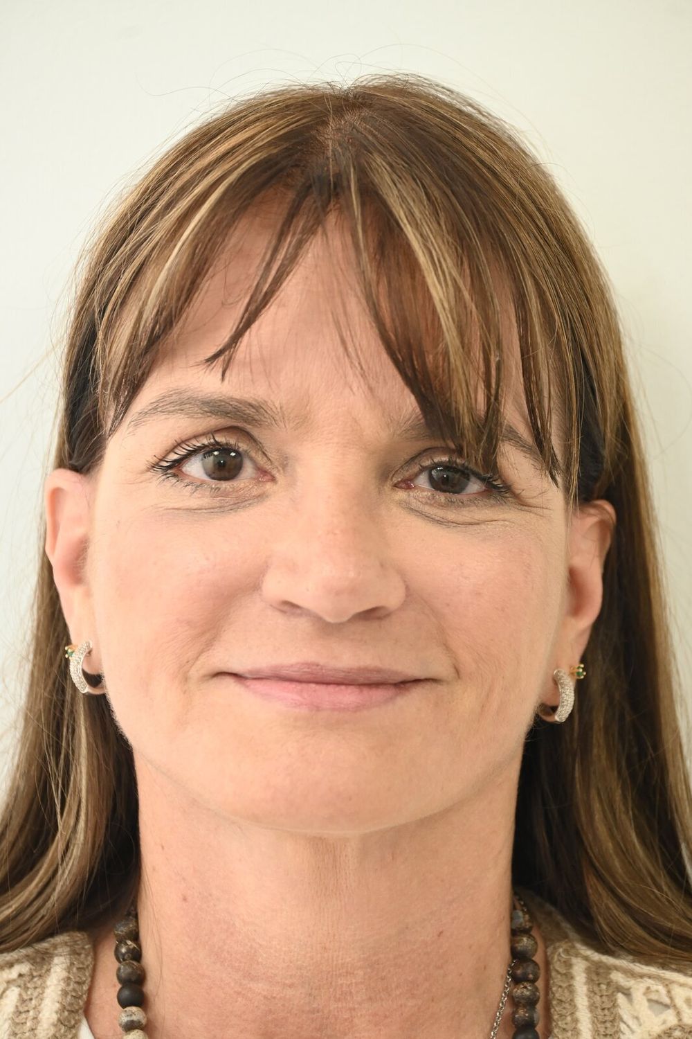 Estiramiento Facial Before & After