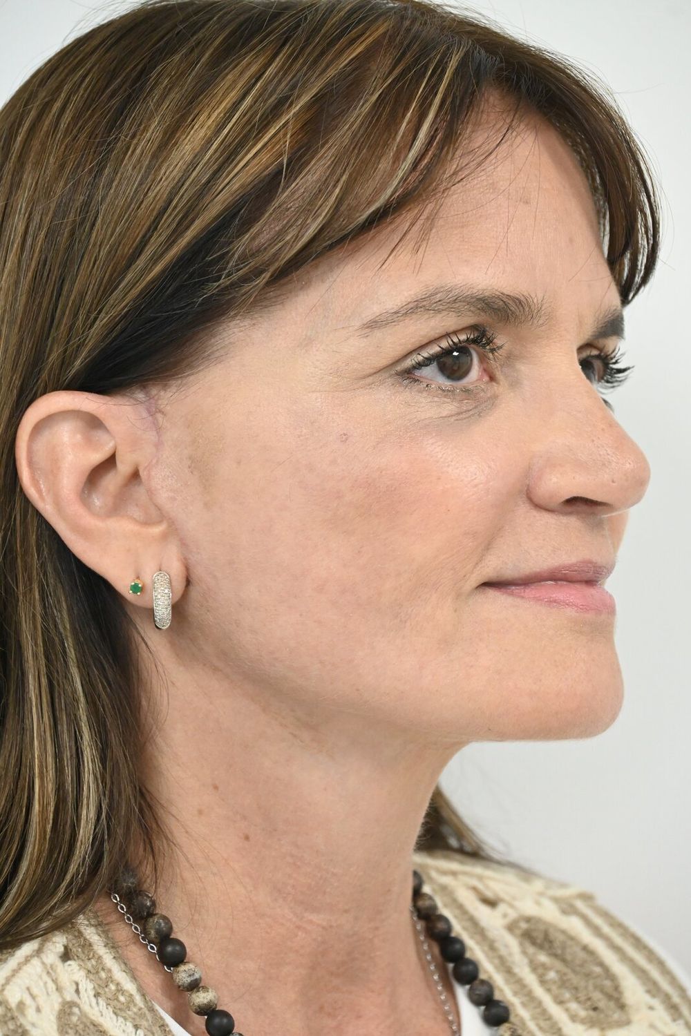 Estiramiento Facial Before & After