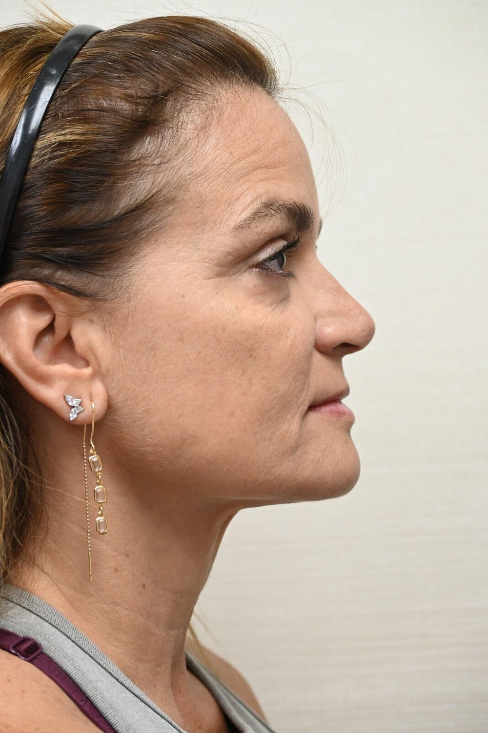 Estiramiento Facial Before & After