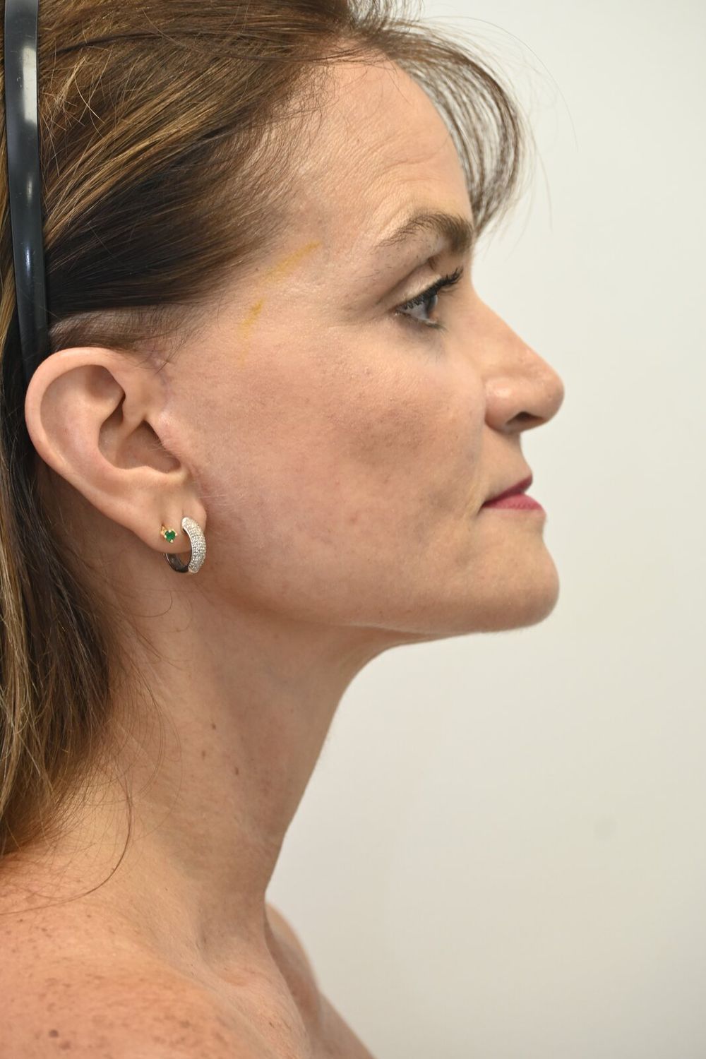 Estiramiento Facial Before & After