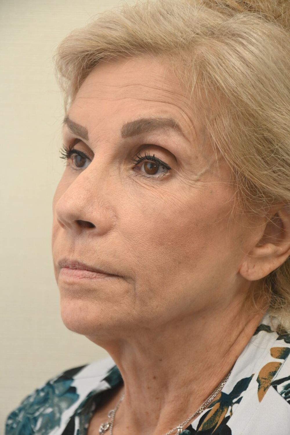 Estiramiento Facial Before & After