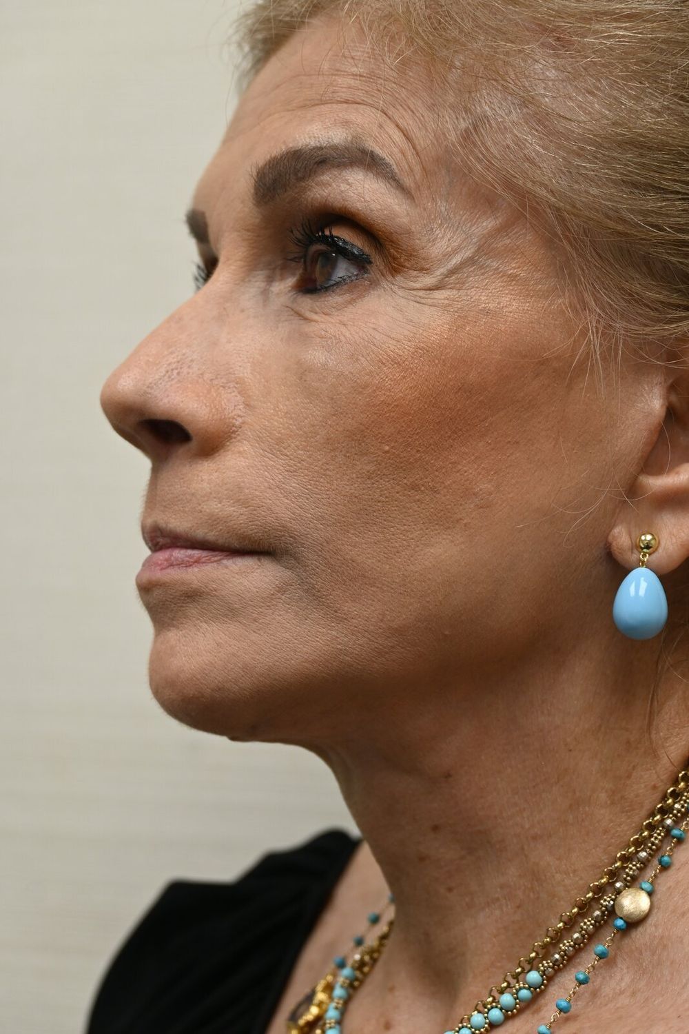 Estiramiento Facial Before & After