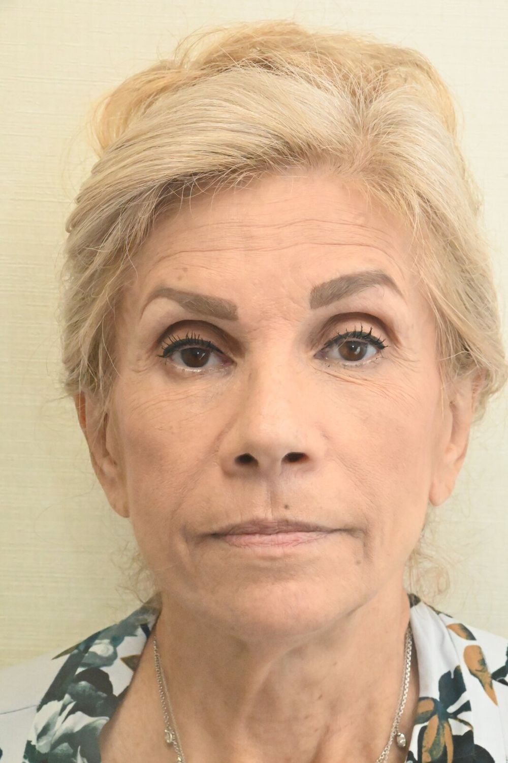 Estiramiento Facial Before & After