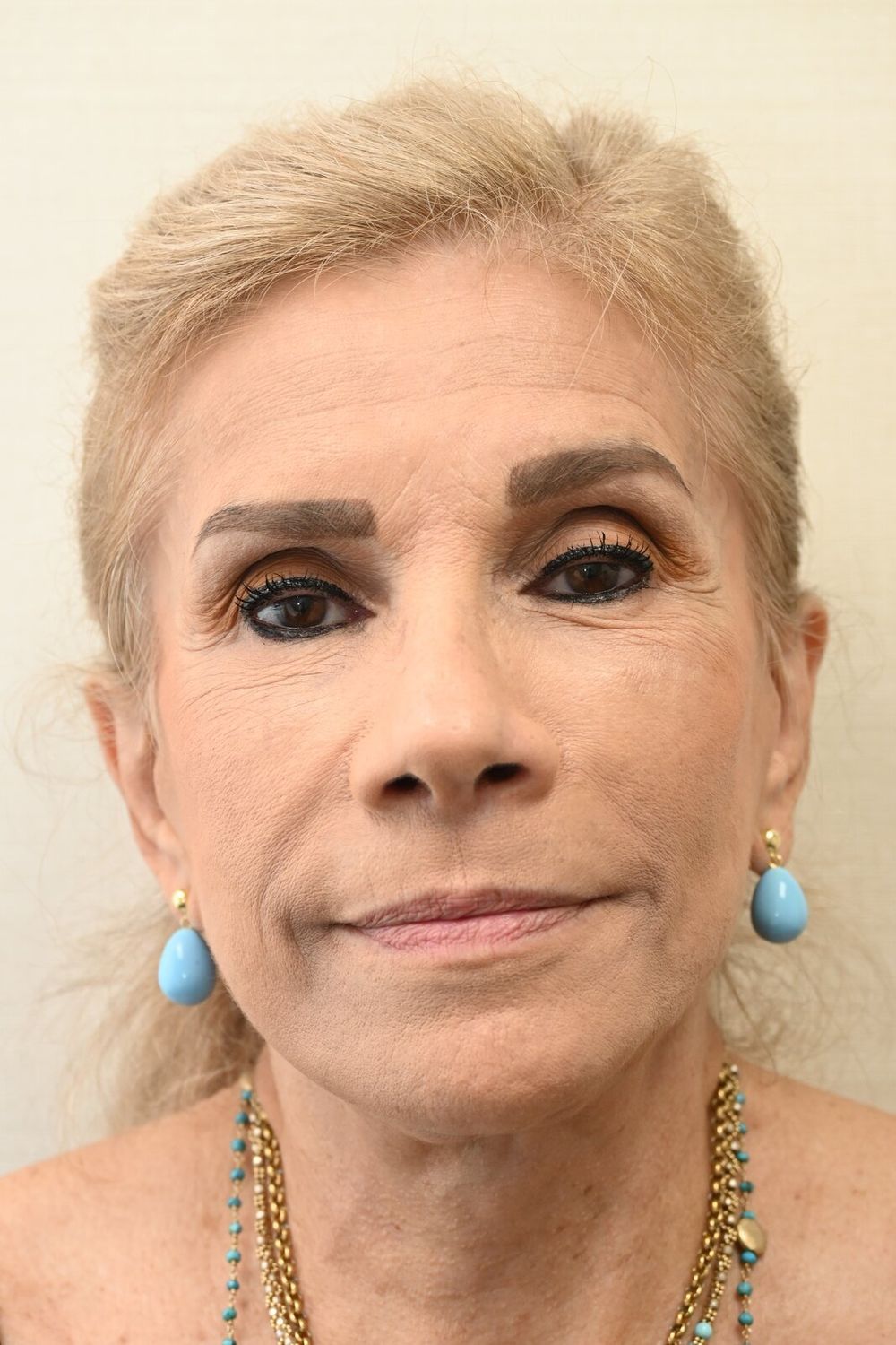 Estiramiento Facial Before & After