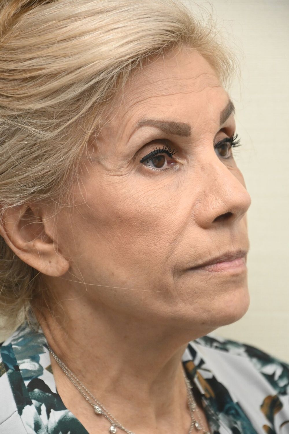 Estiramiento Facial Before & After