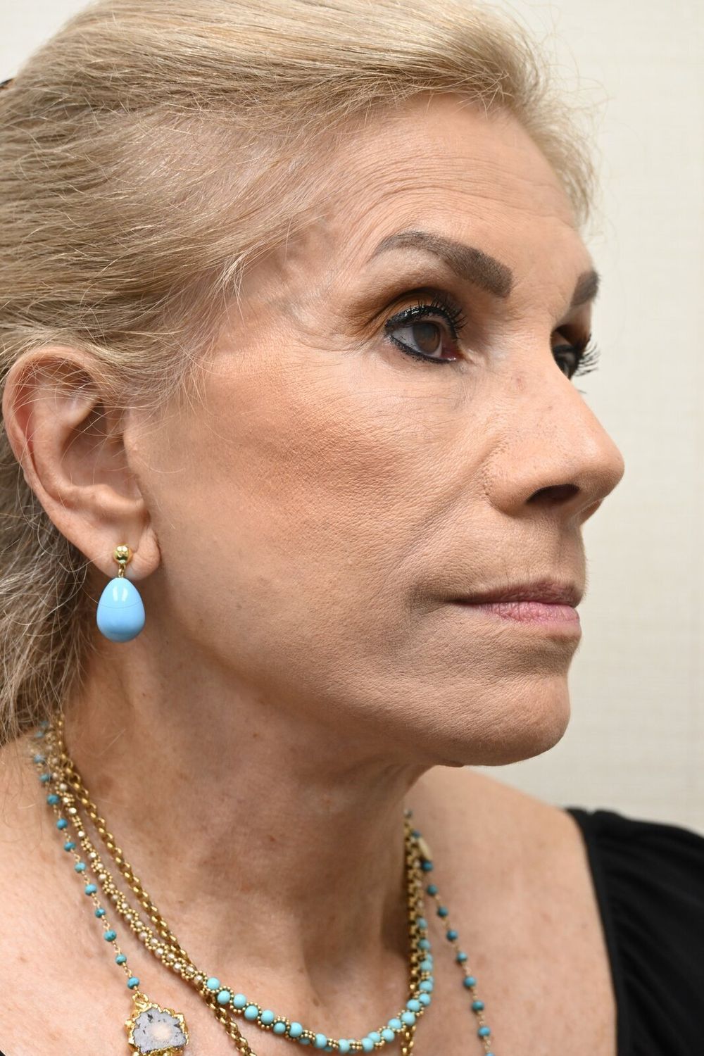 Estiramiento Facial Before & After