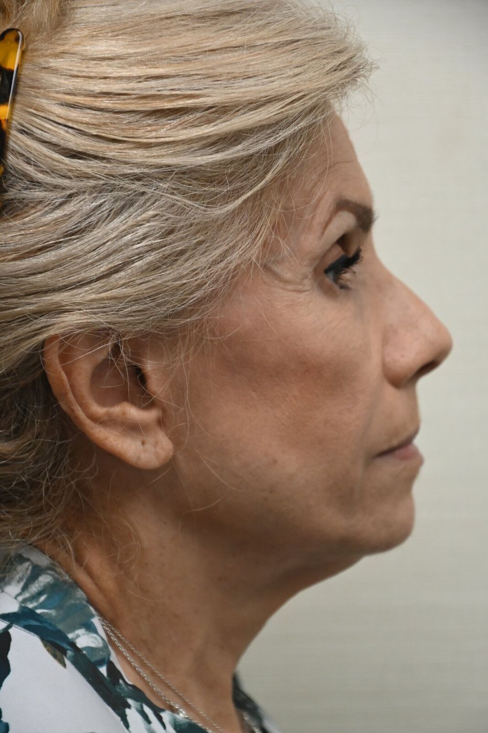 Estiramiento Facial Before & After