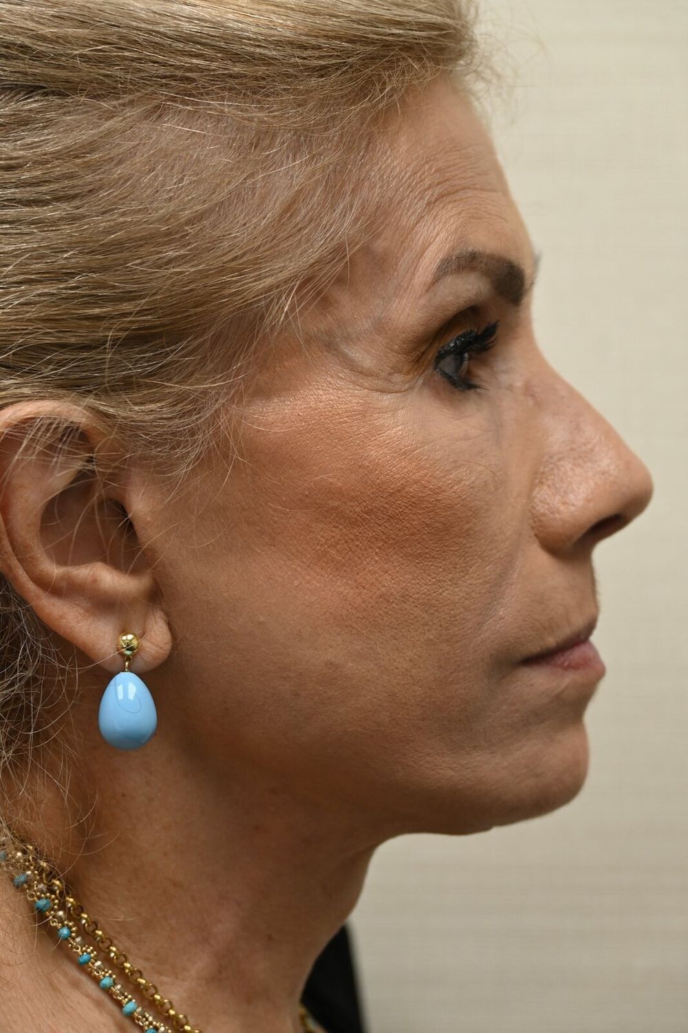 Estiramiento Facial Before & After