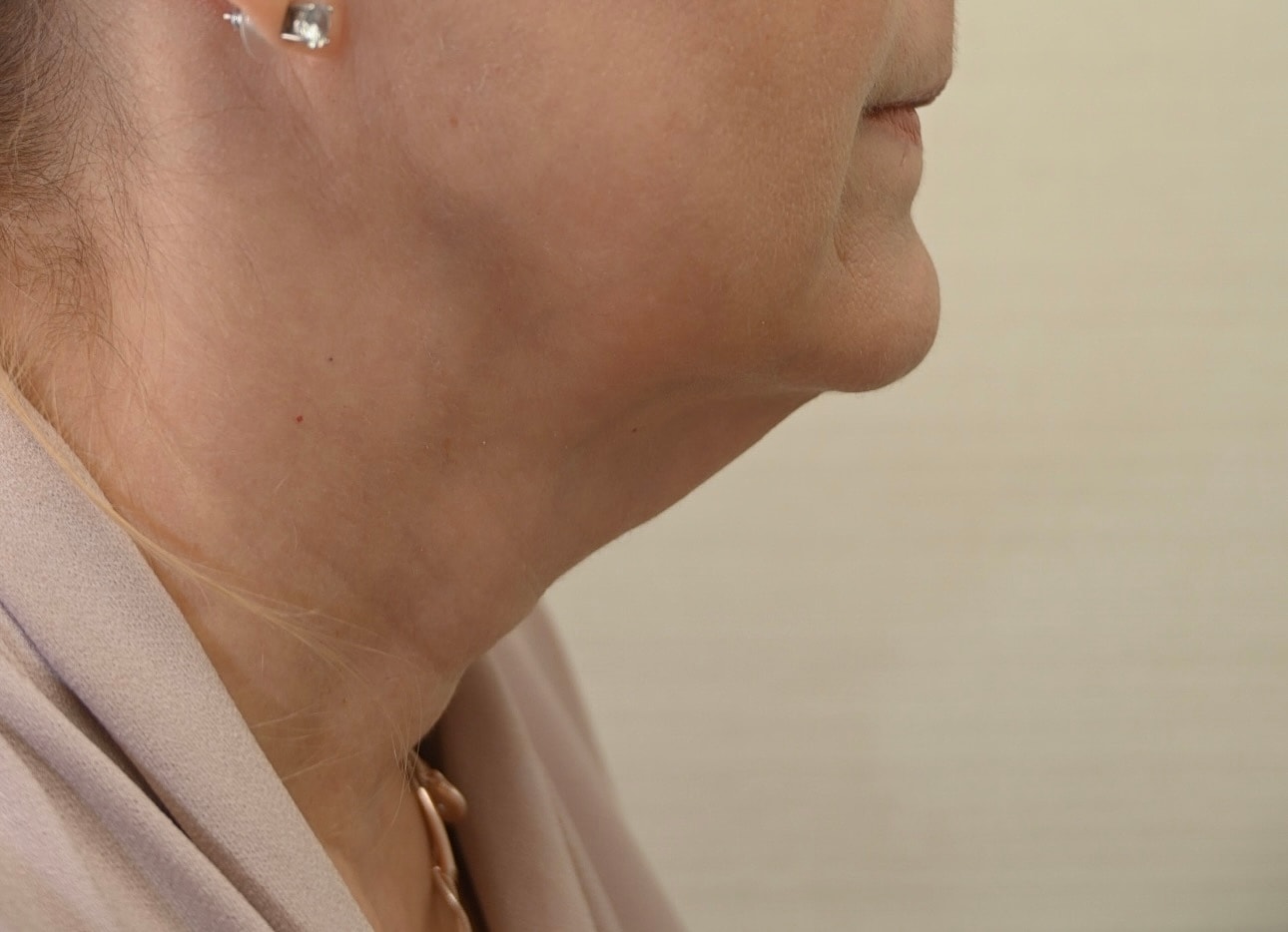 Estiramiento Facial Before & After