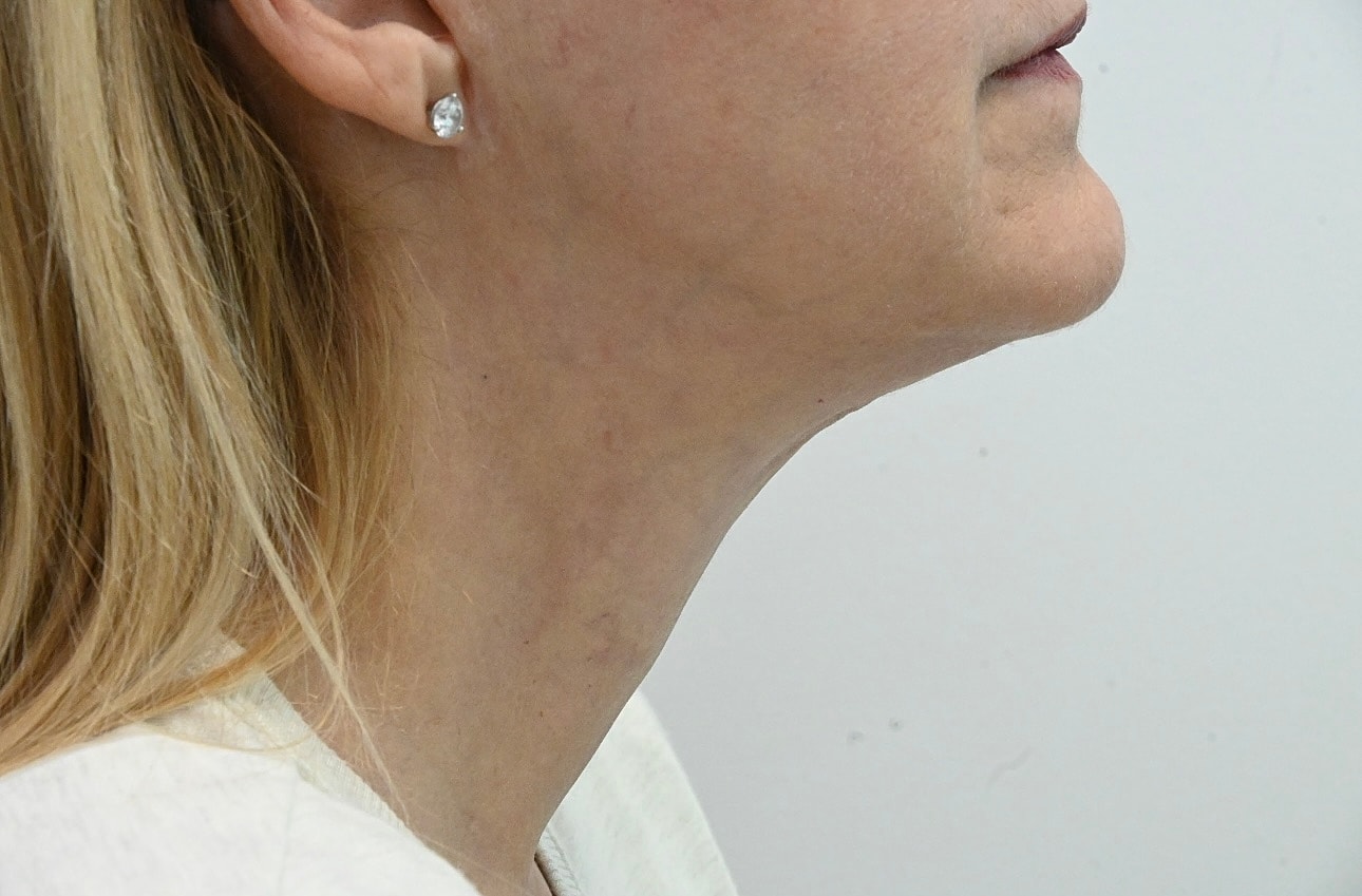 Estiramiento Facial Before & After