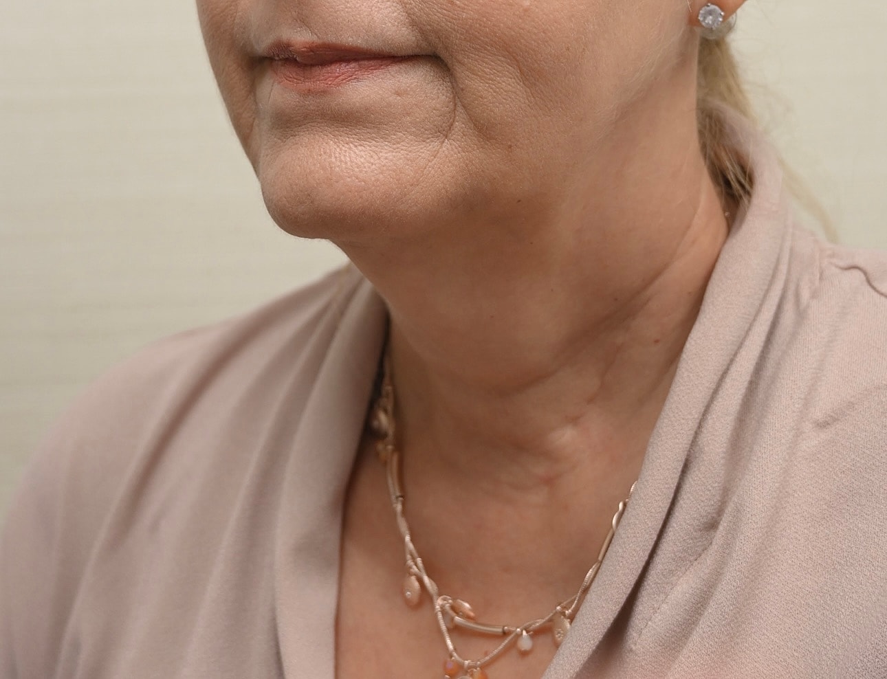 Estiramiento Facial Before & After