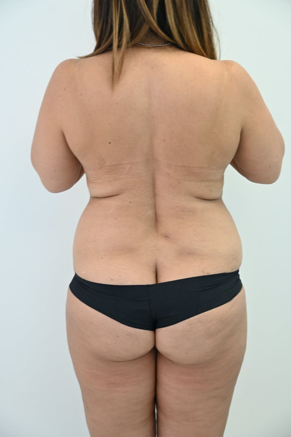 Liposuccion Espalda Before & After