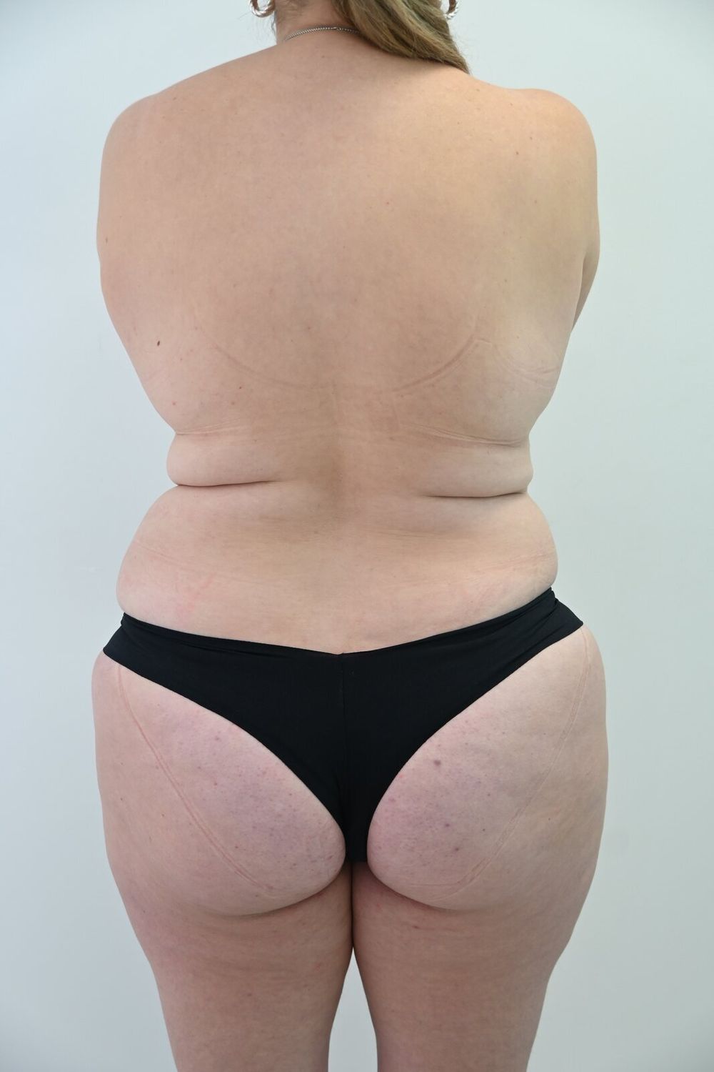 Liposuccion Espalda Before & After