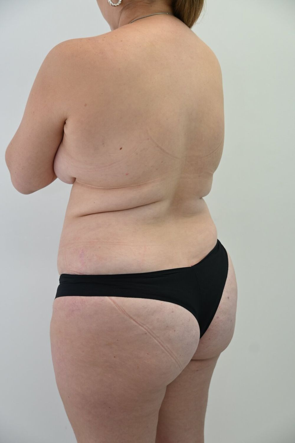 Liposuccion Espalda Before & After