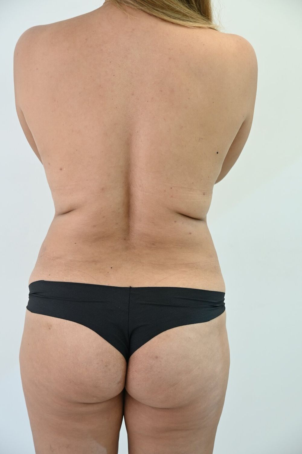 Liposuccion Espalda Before & After