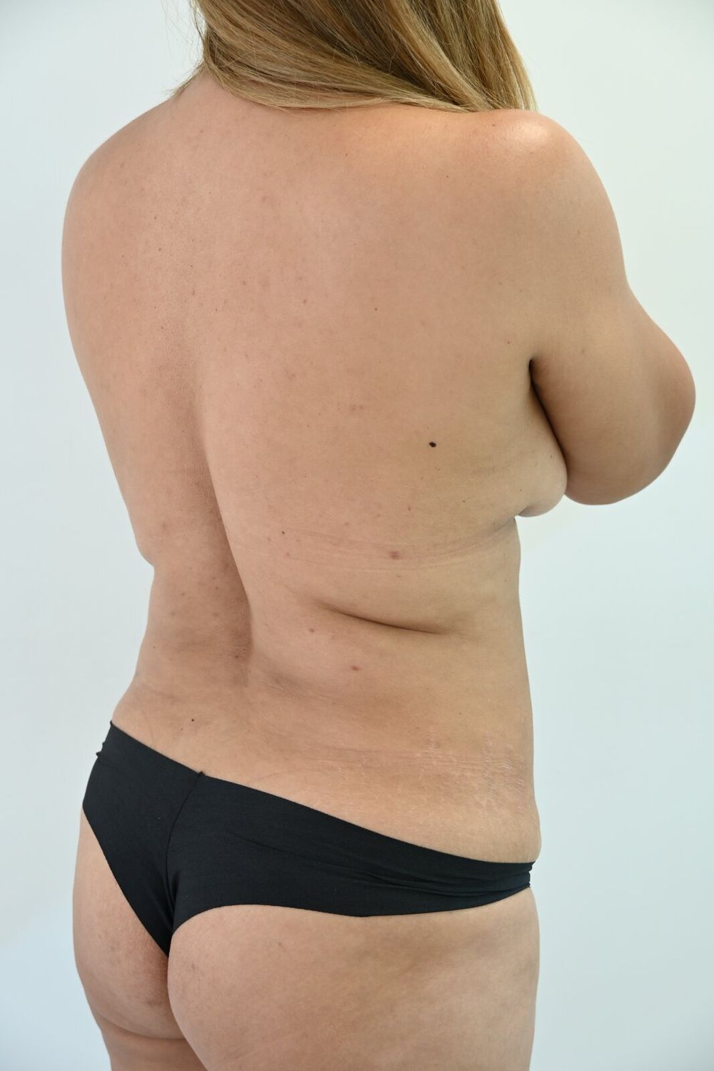 Liposuccion Espalda Before & After