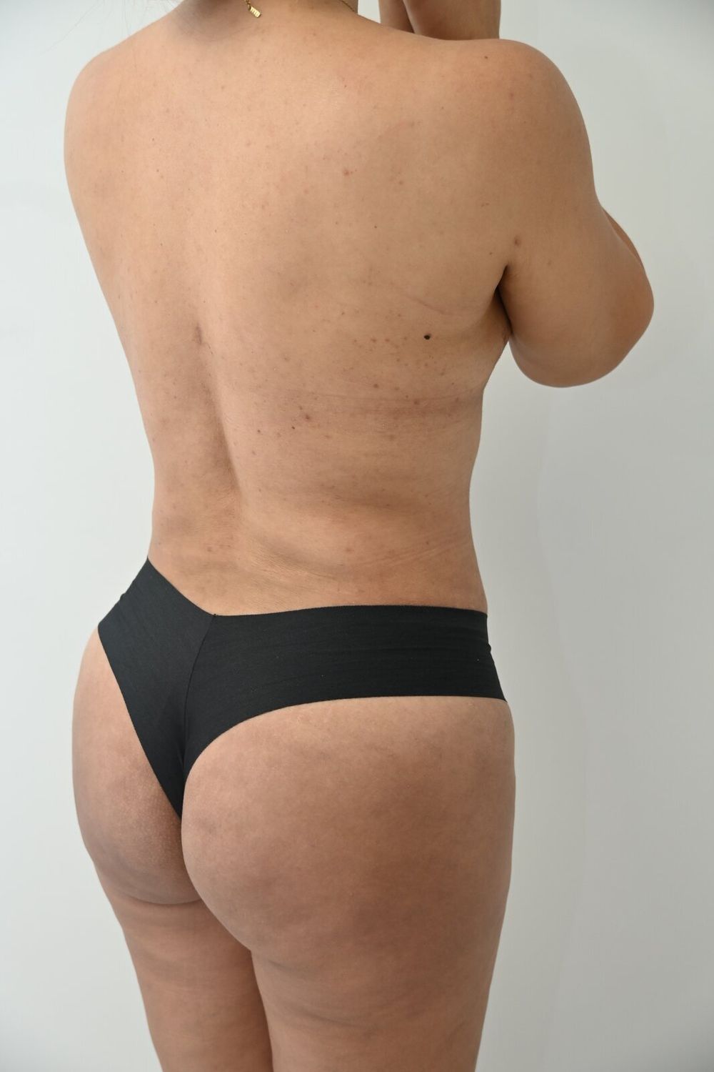 Liposuccion Espalda Before & After