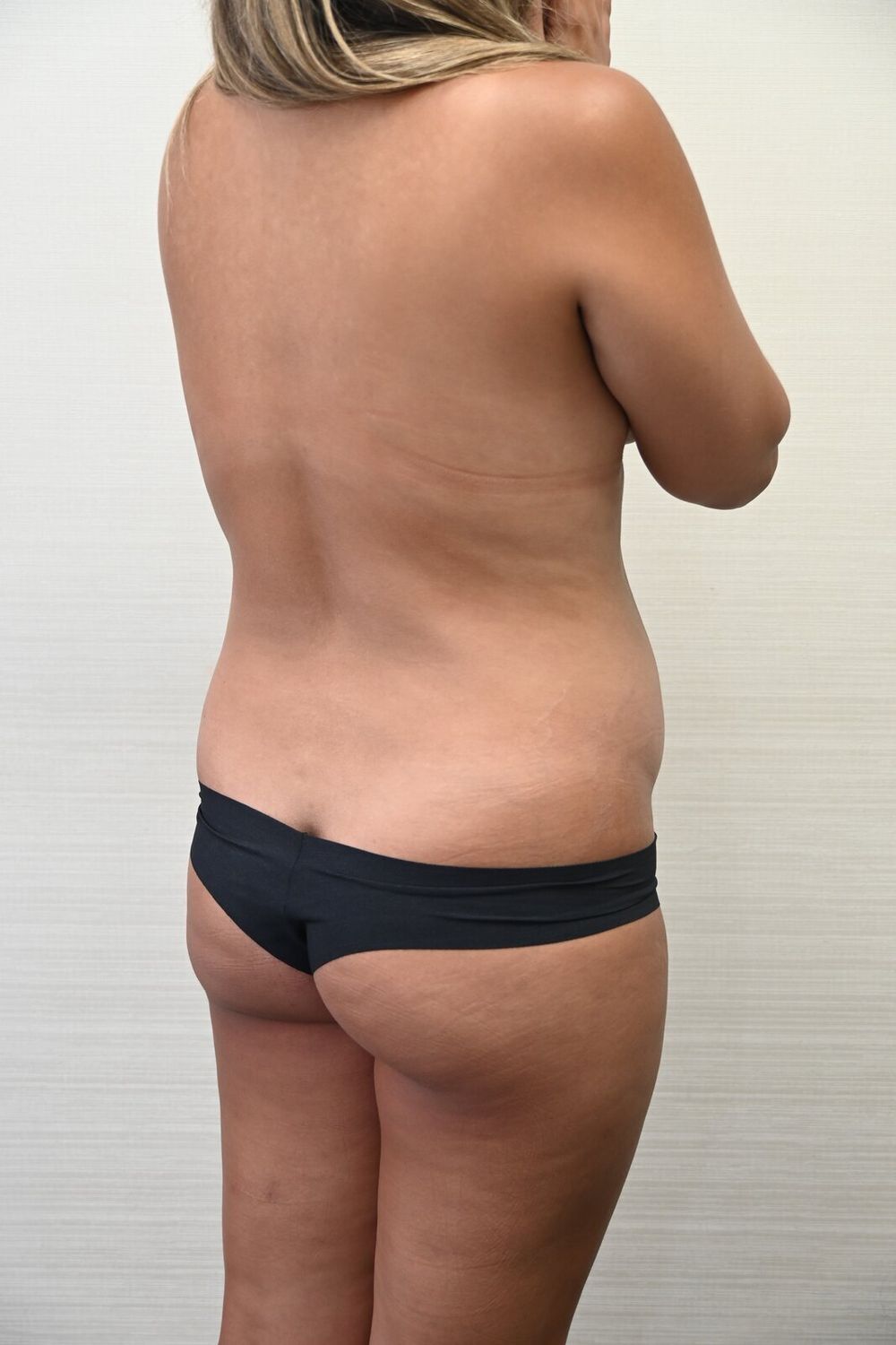 Liposuccion Espalda Before & After