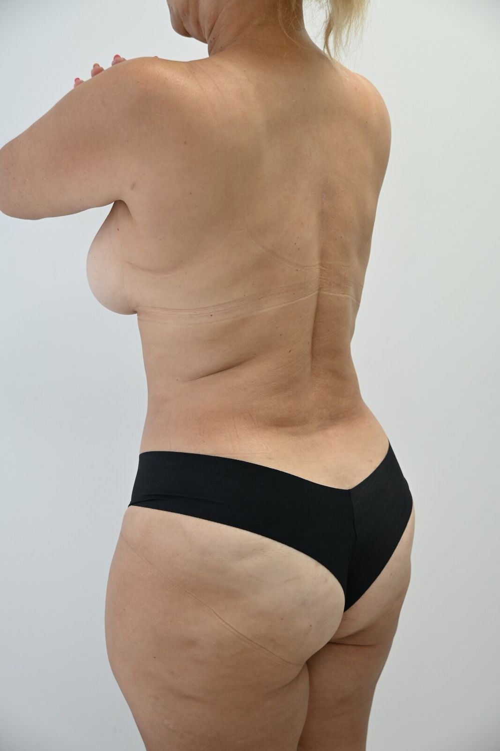 Liposuccion Espalda Before & After