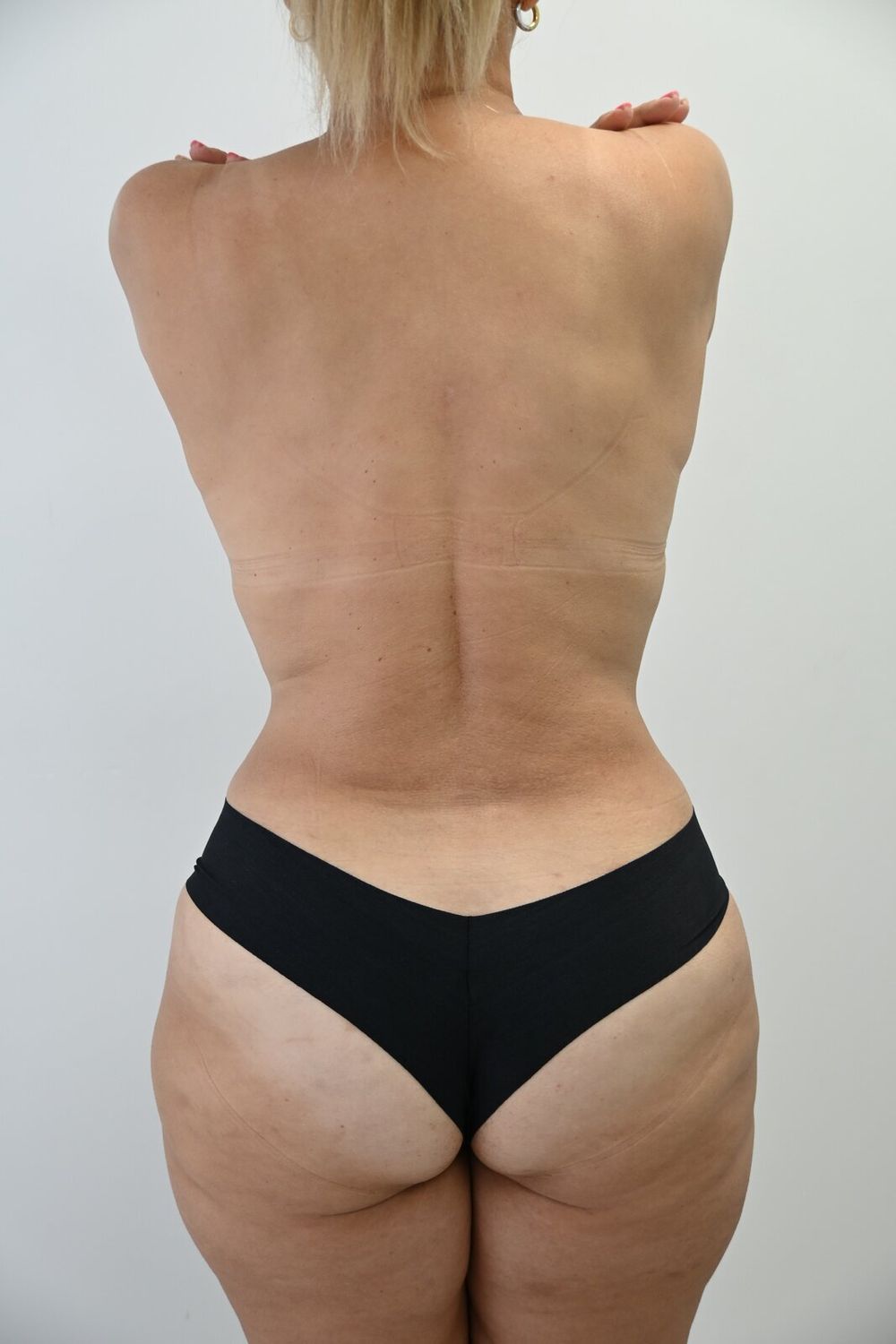 Liposuccion Espalda Before & After