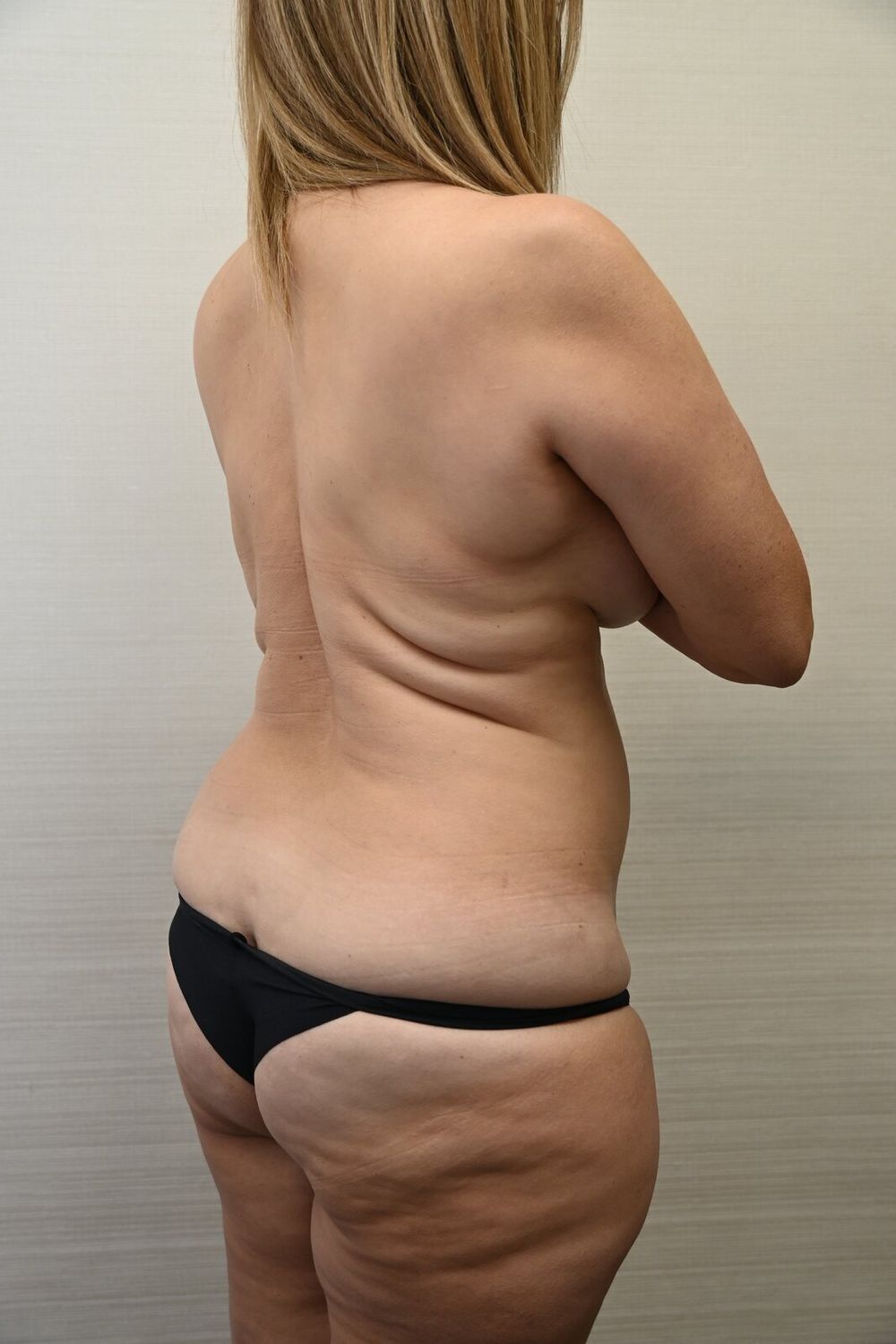 Liposuccion Espalda Before & After