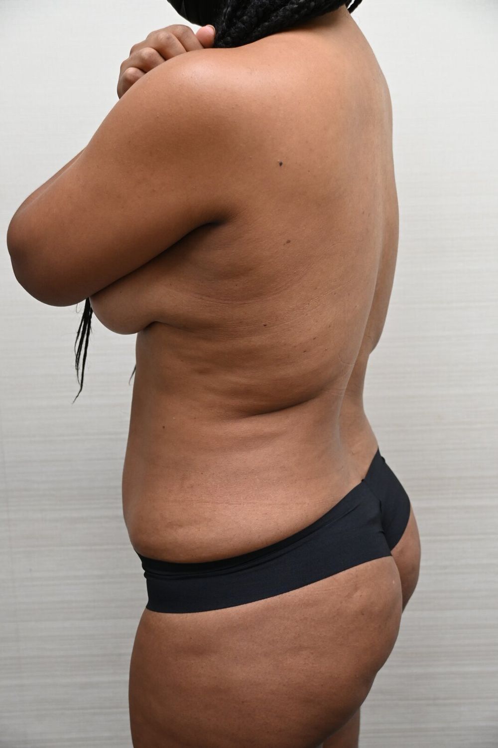 Liposuccion Espalda Before & After
