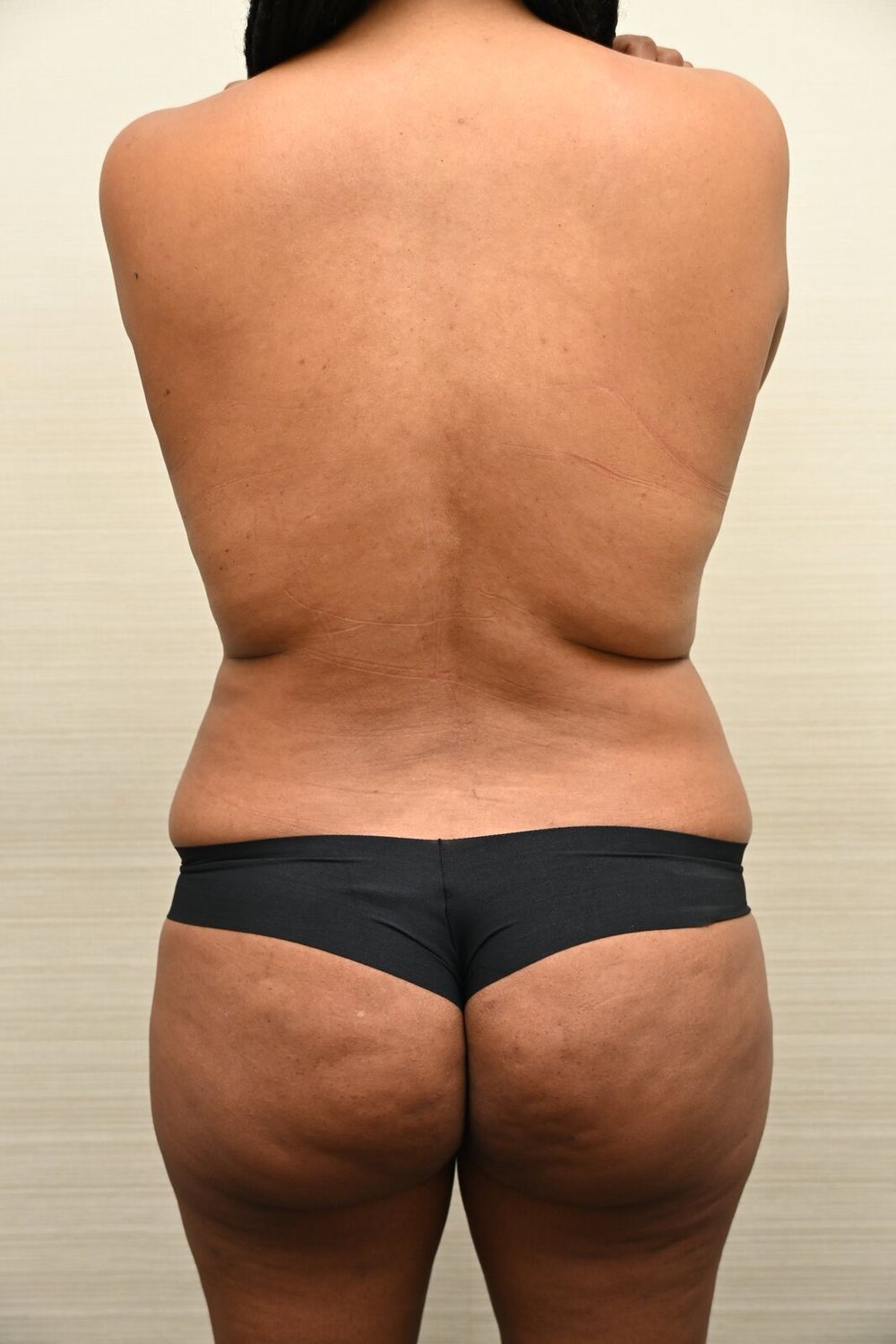 Liposuccion Espalda Before & After