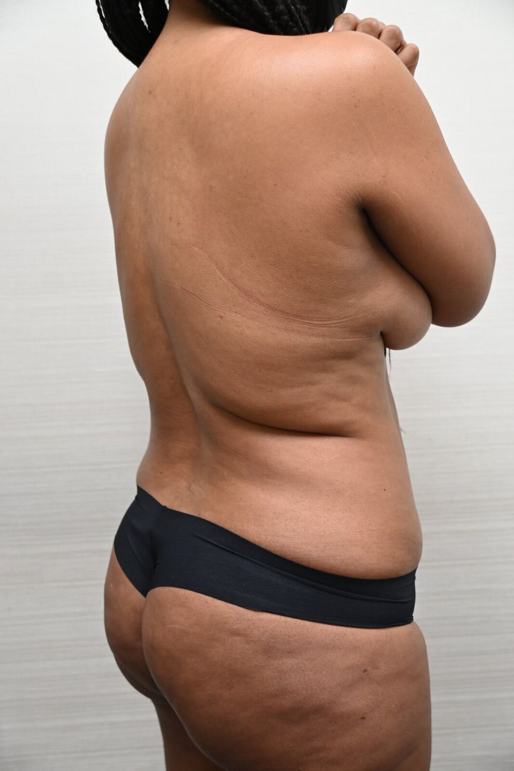 Liposuccion Espalda Before & After