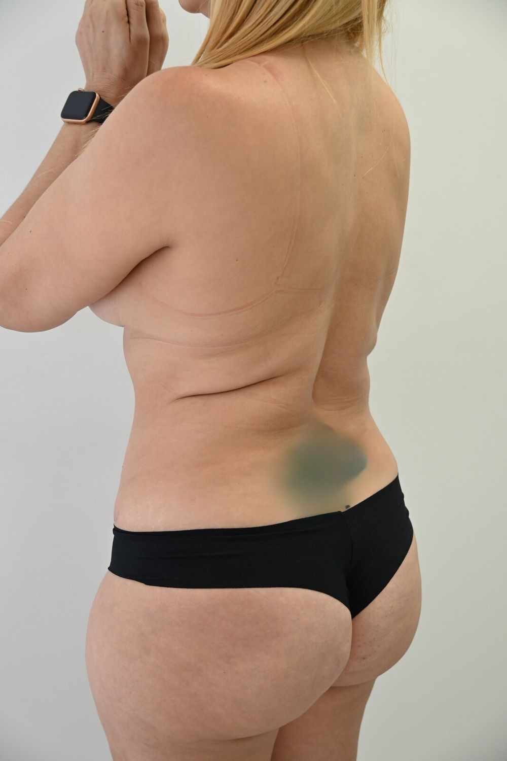 Liposuccion Espalda Before & After