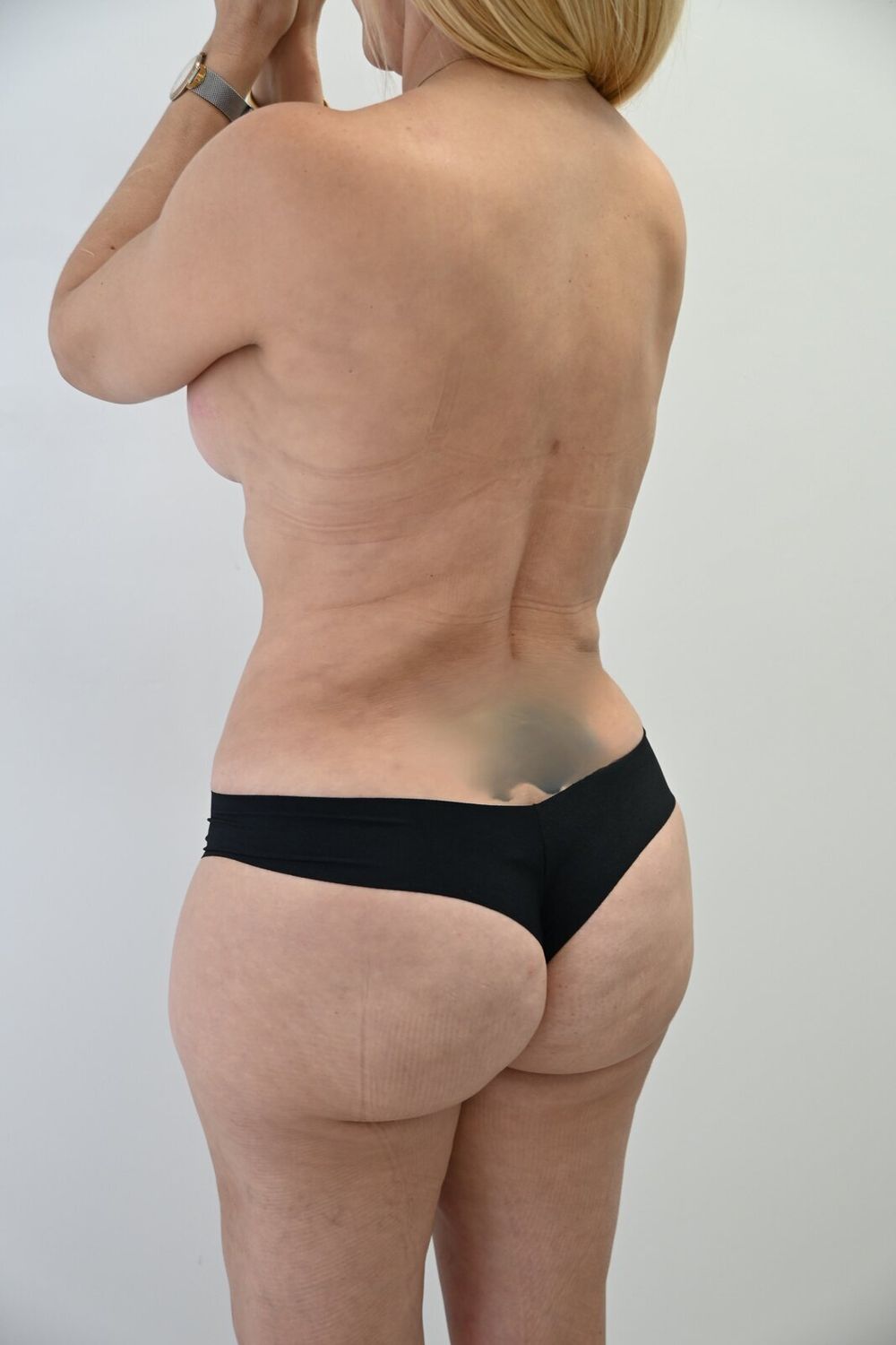 Liposuccion Espalda Before & After