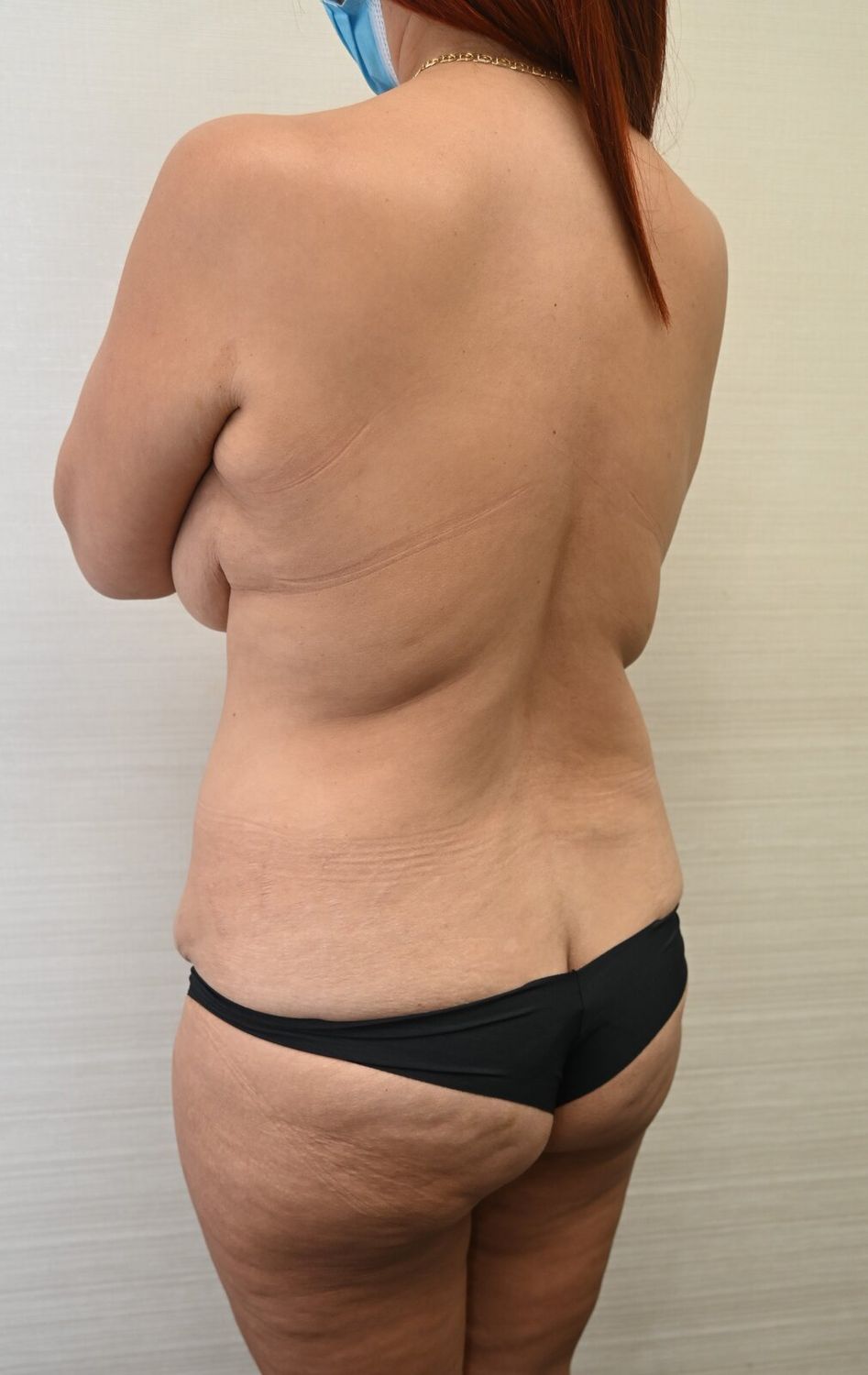 Liposuccion Espalda Before & After