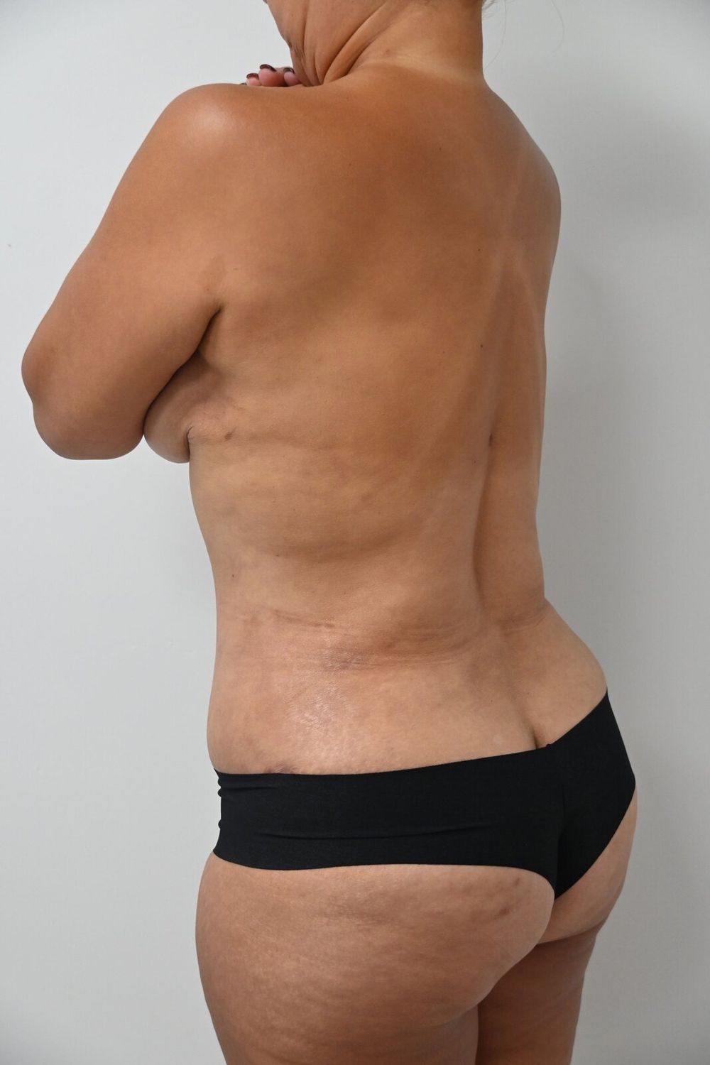 Liposuccion Espalda Before & After
