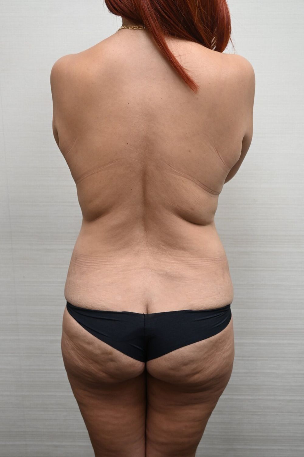 Liposuccion Espalda Before & After