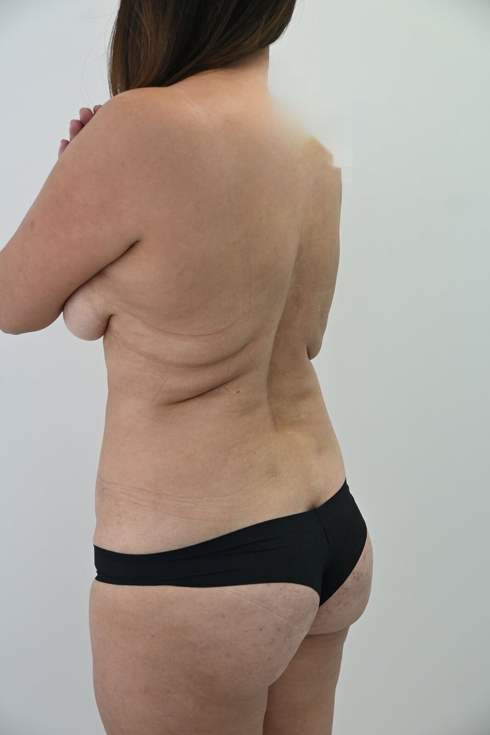 Liposuccion Espalda Before & After
