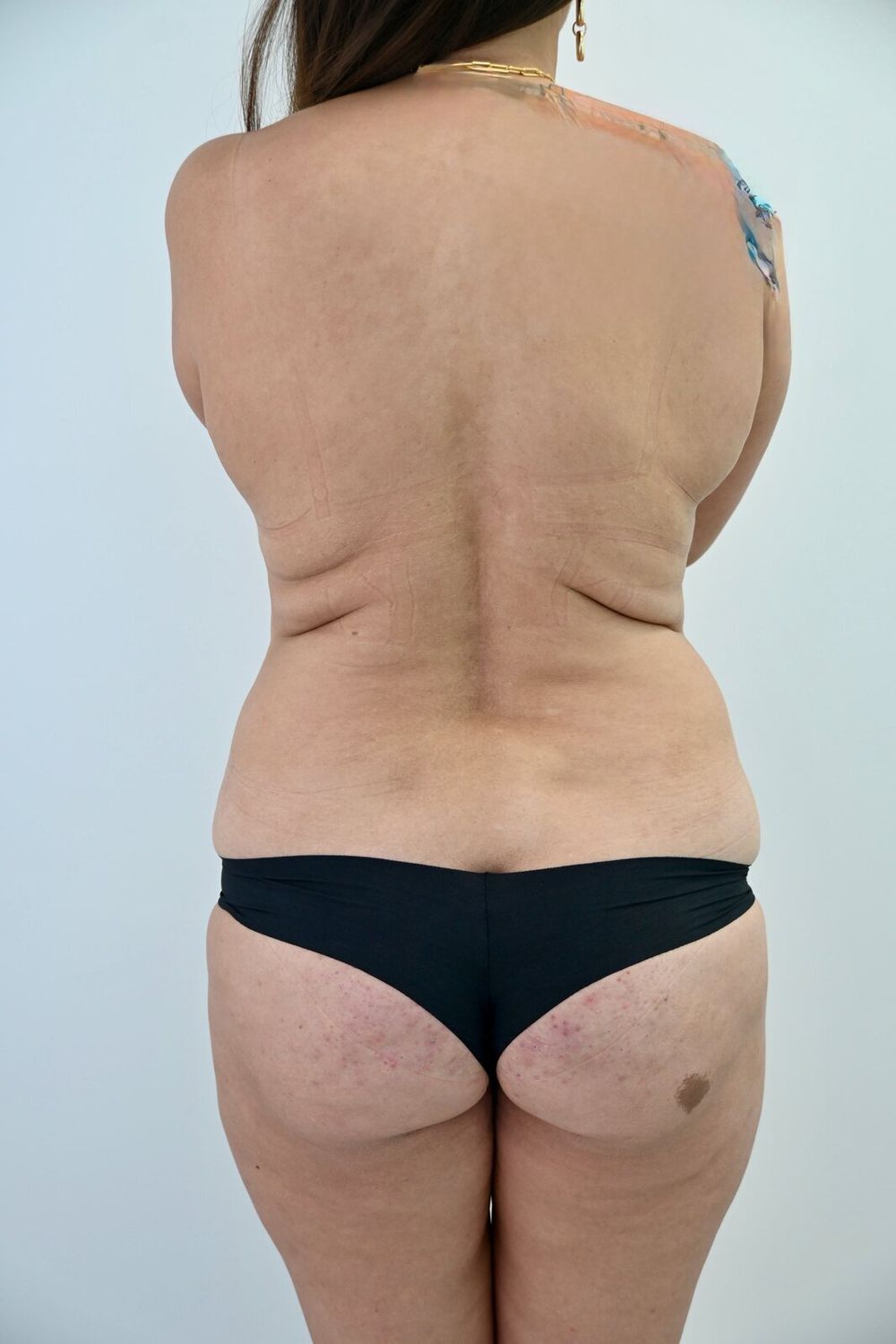 Liposuccion Espalda Before & After