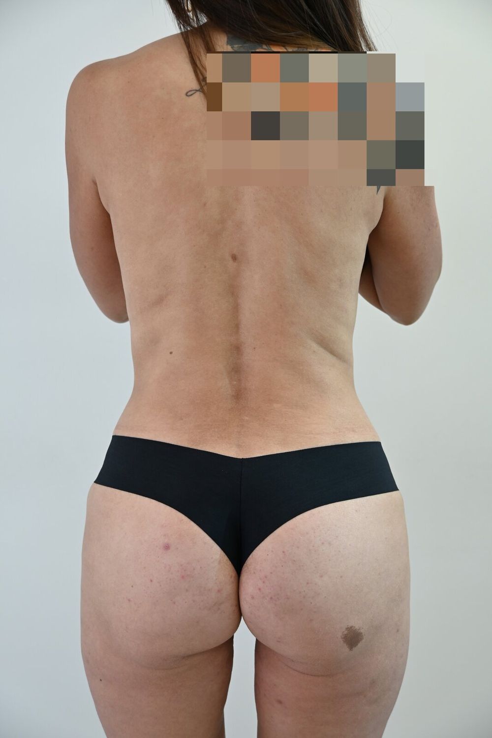 Liposuccion Espalda Before & After