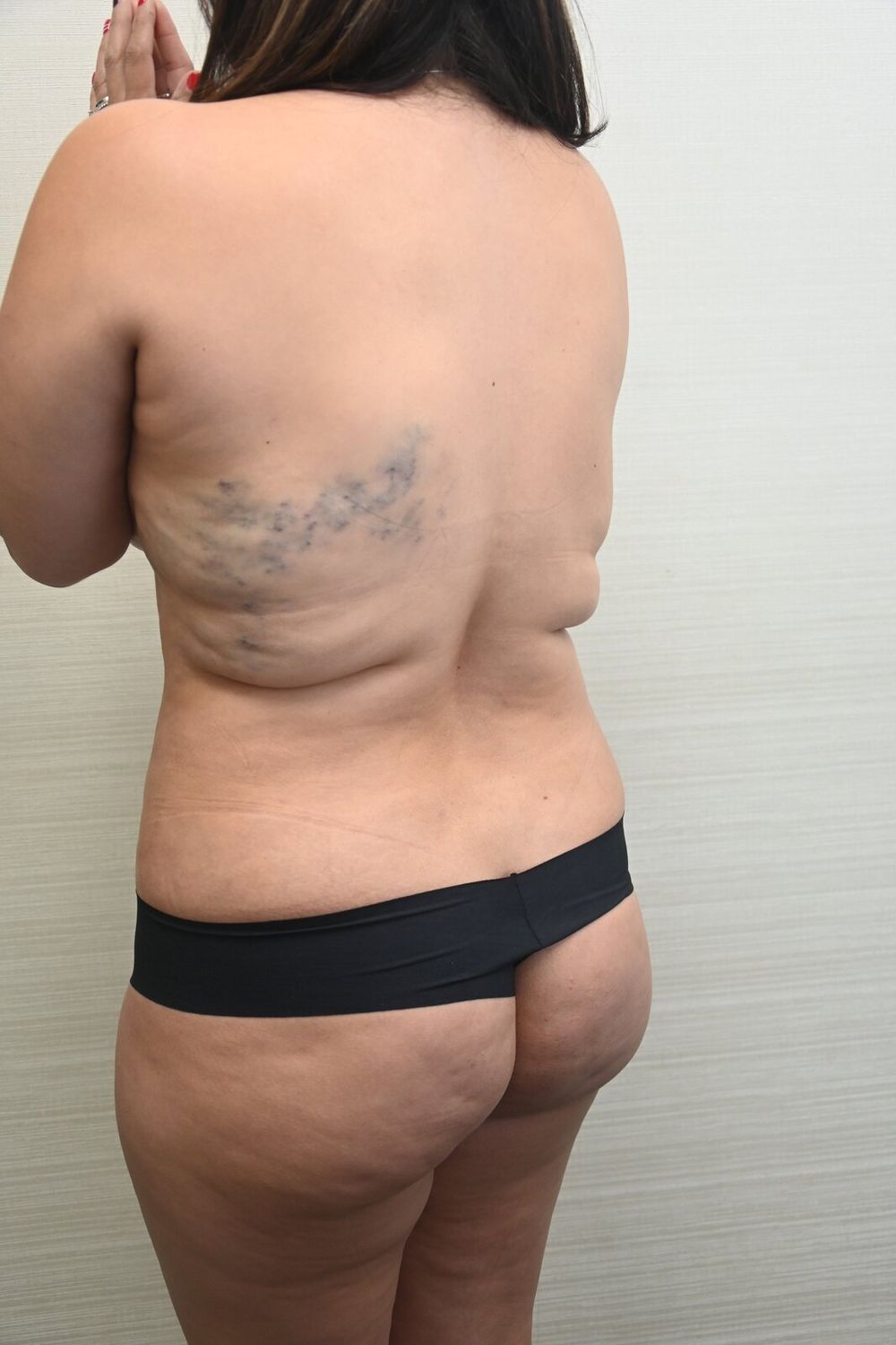 Liposuccion Espalda Before & After
