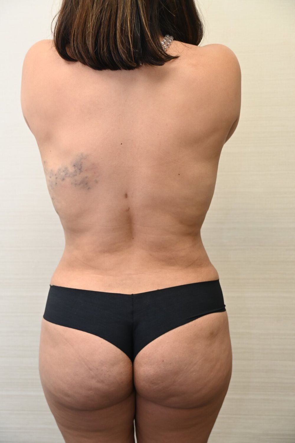 Liposuccion Espalda Before & After