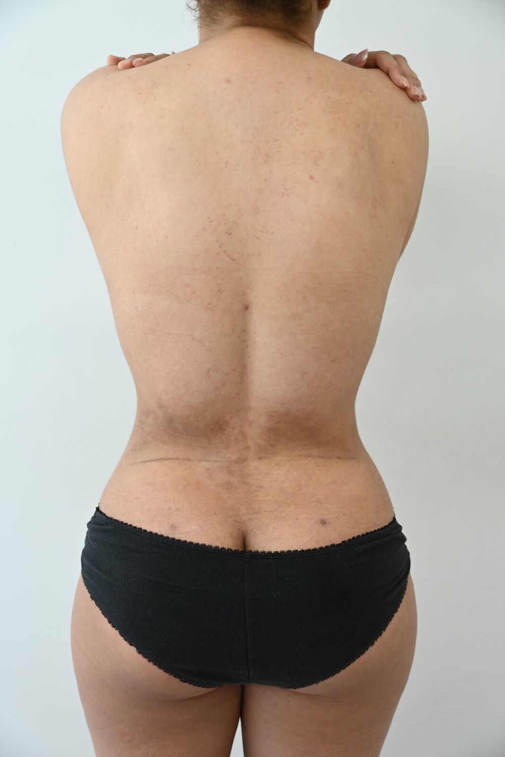 Liposuccion Espalda Before & After