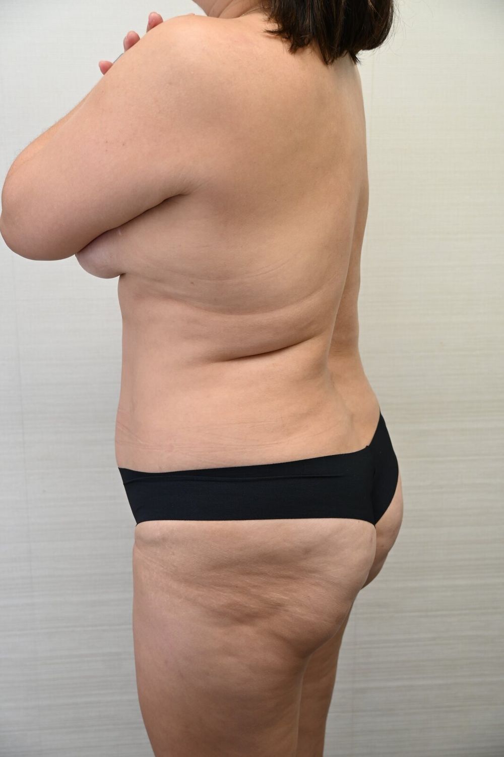 Liposuccion Espalda Before & After