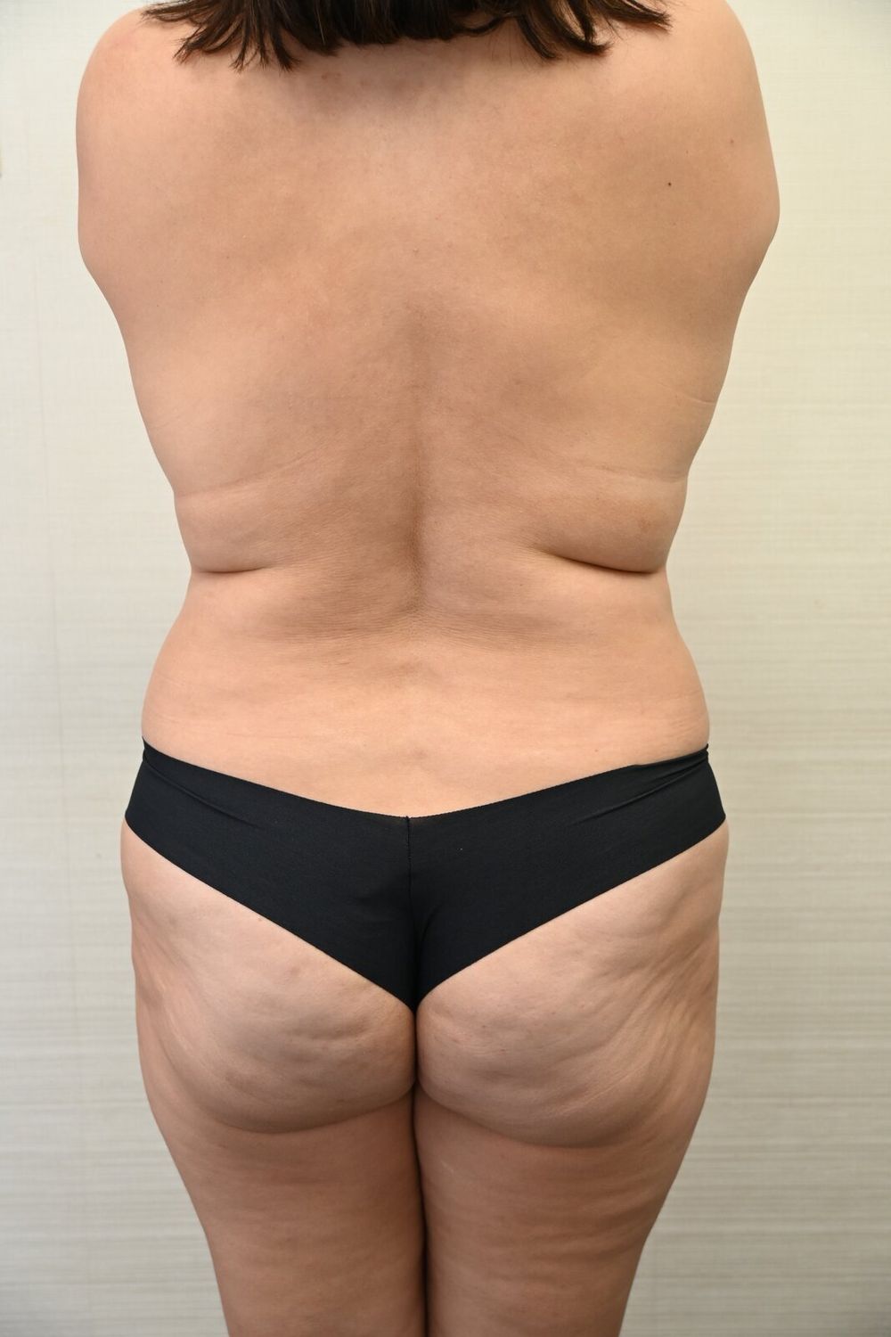 Liposuccion Espalda Before & After