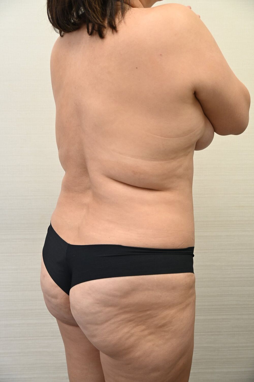 Liposuccion Espalda Before & After