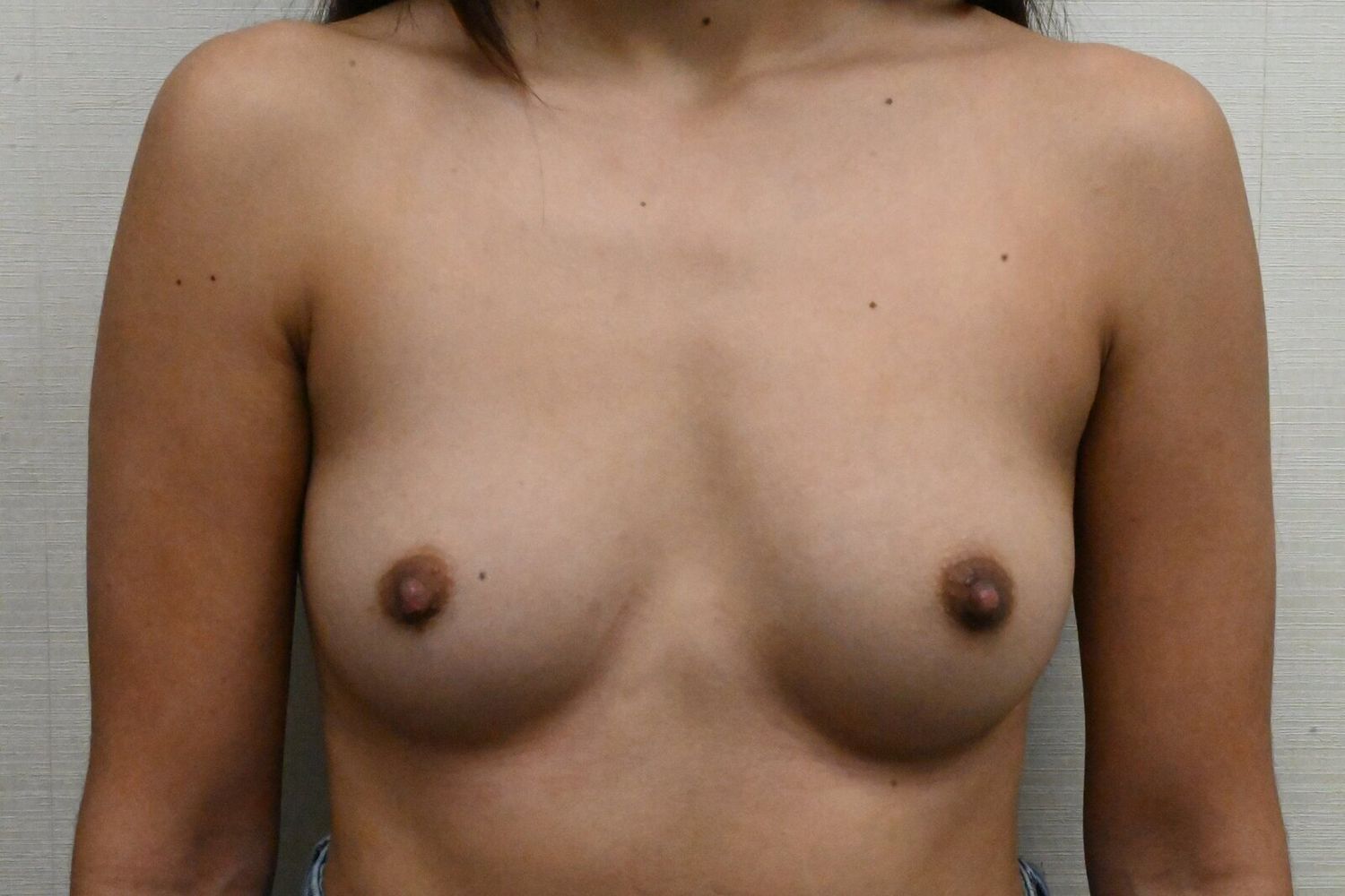 Aumento De Senos Before & After