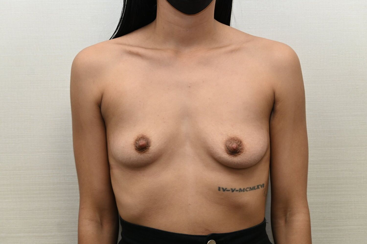 Aumento De Senos Before & After