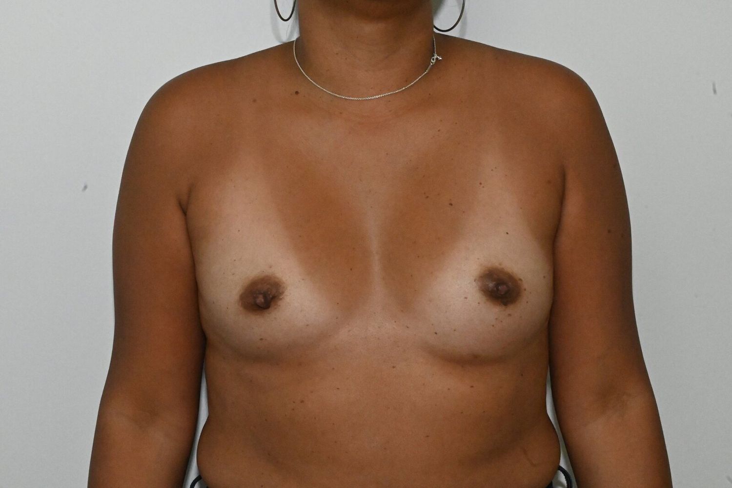 Aumento De Senos Before & After