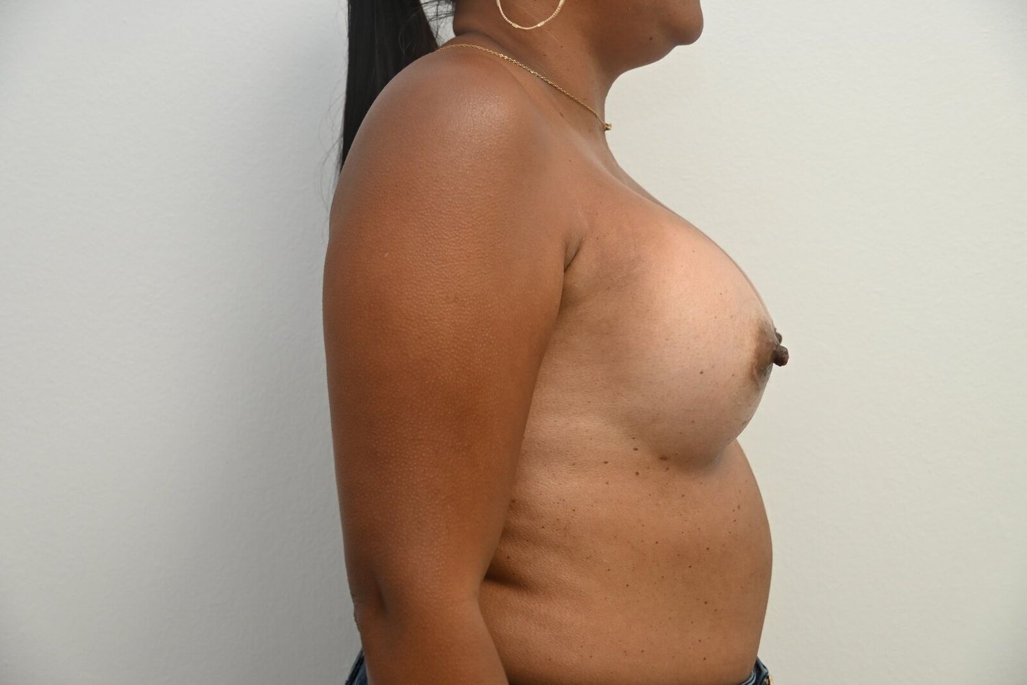 Aumento De Senos Before & After