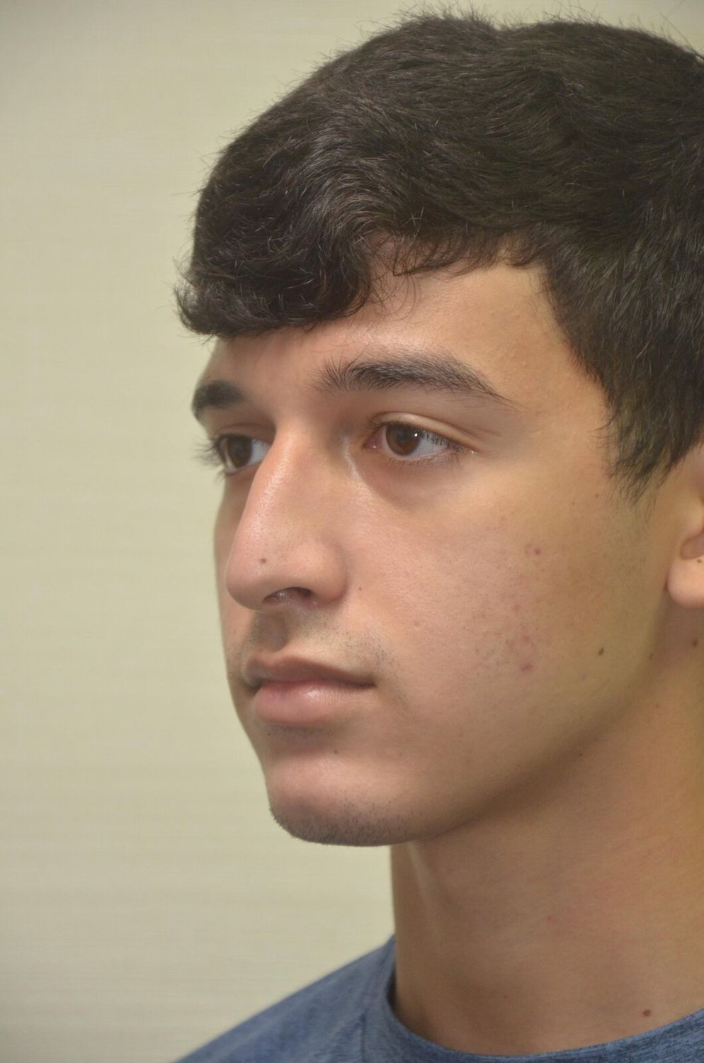 Rinoplastia Before & After