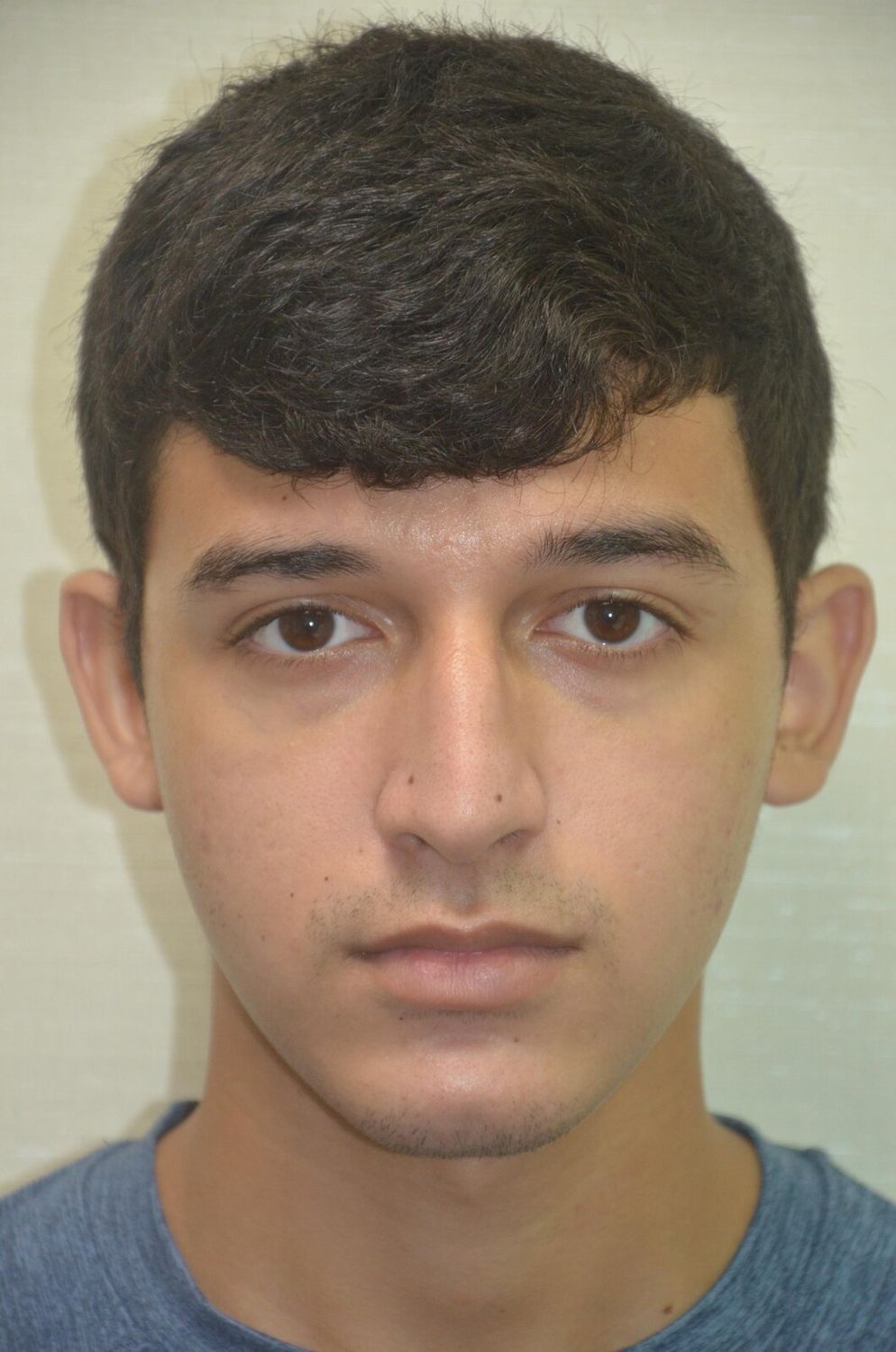 Rinoplastia Before & After