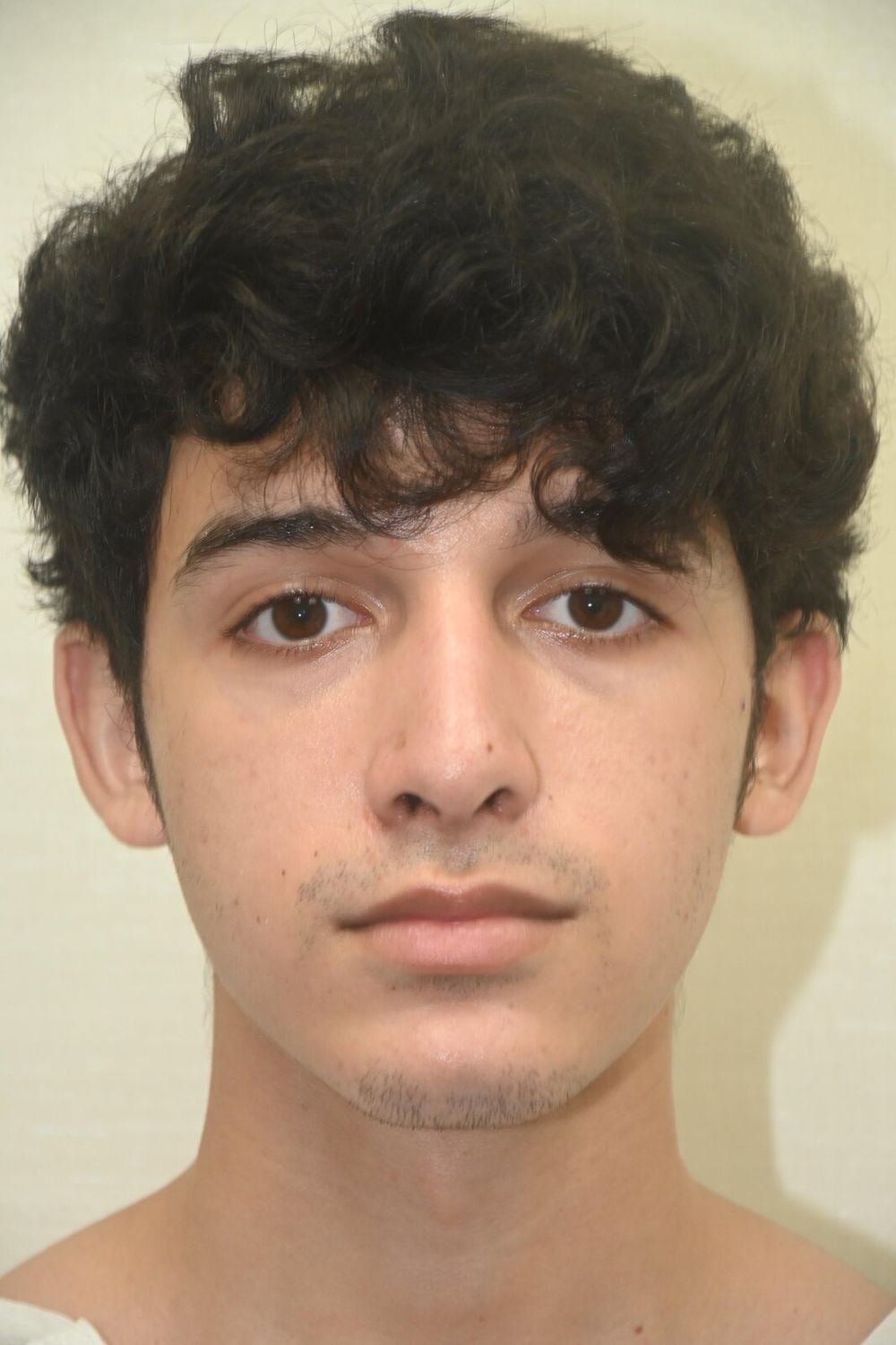 Rinoplastia Before & After