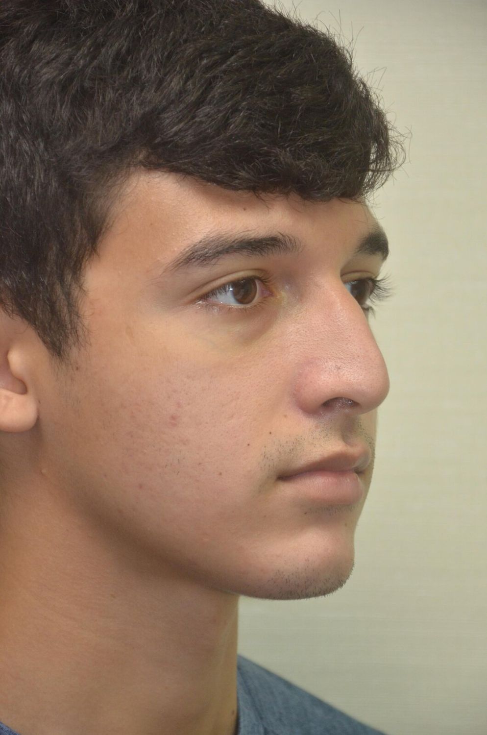 Rinoplastia Before & After